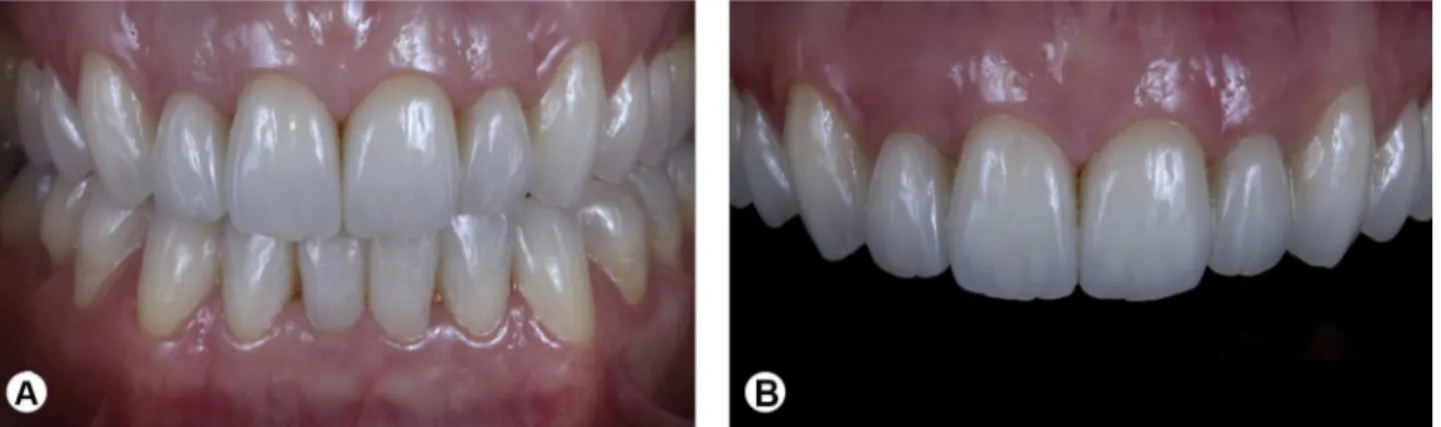Figure 8. Intraoral views of the final appearance immediately after cementation: (A) maximum intercuspation and (B) maxillary anterior teeth.