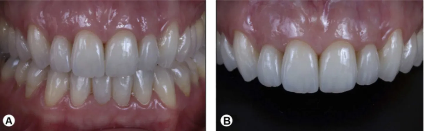 Figure 10. Intraoral views of the clinical follow-up evaluation after 36 months: (A) maximum intercuspation and (B) maxillary anterior teeth.