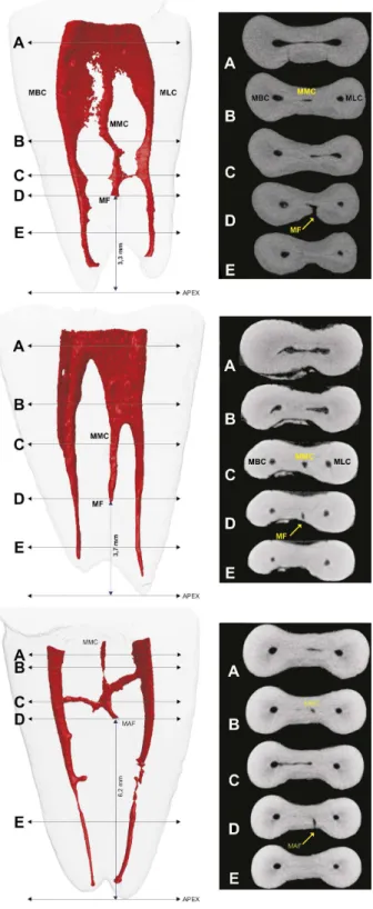 Figure 1. 3D models and cross-sectional images in different levels  of the mesial root of 3 mandibular molars showing the mesiobuccal  canal (MBC), mesiolingual canal (MLC), and the main foramen (MF)  of the middle mesial canal (MMC) located at 3.3 mm, 3.7