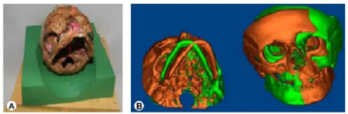 Figure 2. The 20° rotating of the skull (A). The 20° rotation of the  skull three-dimensionally reconstructed from the central position