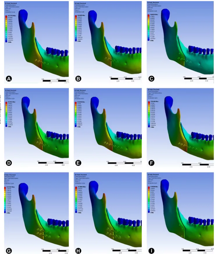 Figure 2. Simulation of bone segment displacement with the 9 different fixation methods.