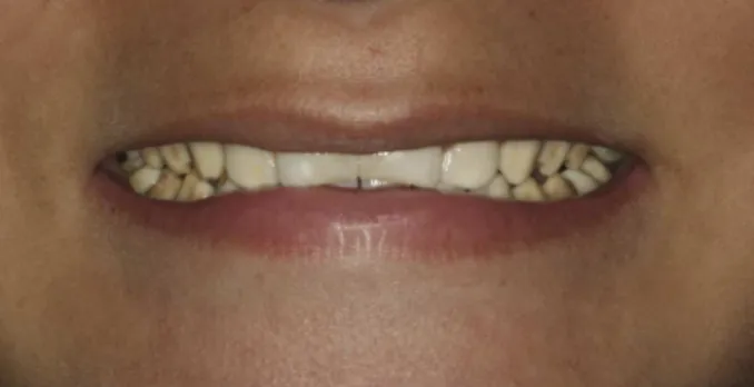 Figure 1. Initial aspect of the teeth.