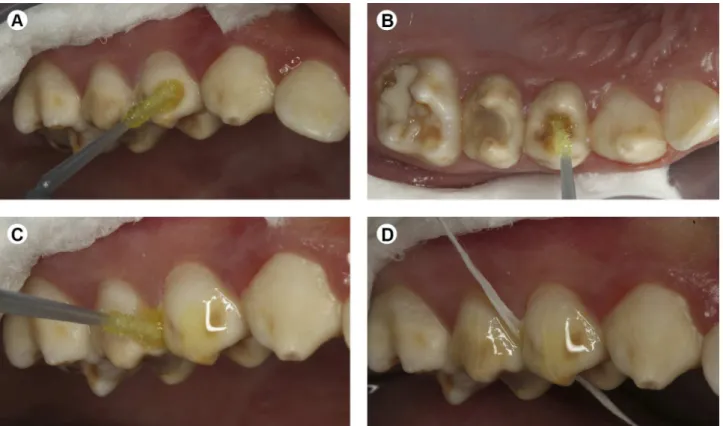 Figure 2. Application of the adhesive system on the buccal (A), occlusal (B) and proximal (C,D) surfaces.