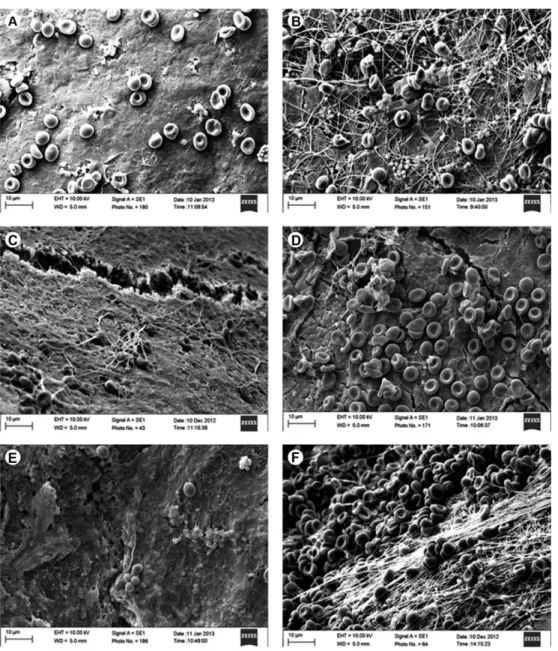 Figure 3. Effect of surface treatment on fibrin clot formation on dentin. (A) Control group, (B) root surface scaling and root planning, (C) citric  acid, (D) EDTA, (E) tetracycline capsule, and (F) tetracycline gel (Original magnification ×3000).