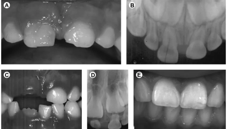 Figure 1. Crown-root fracture in maxillary right central primary incisor. Multiple fracture lines in the crown (A) and simple fracture line in the  root (B)