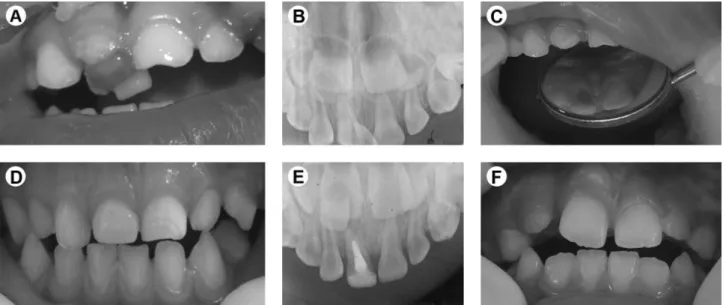 Figure 3. Crown-root fracture in maxillary left central primary incisor. Multiple fracture lines in the crown (A) and simple fracture line in the root  (B)