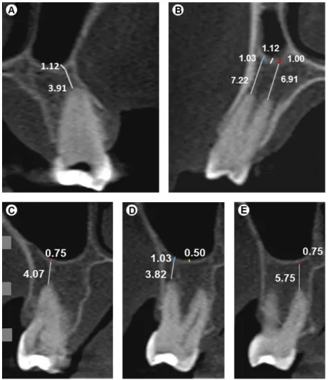 Figure 2. CBCT images. Vertical relationship. A: Type I; B: Type II; C: Type III; D: Type IV; E: Type V
