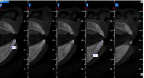 Figure 1. Measuring the length of root canals on the initial CBCT scan.