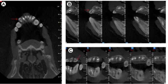 Figure 2. New Tom CBCT image reconstruction. A: Axial view, B: 