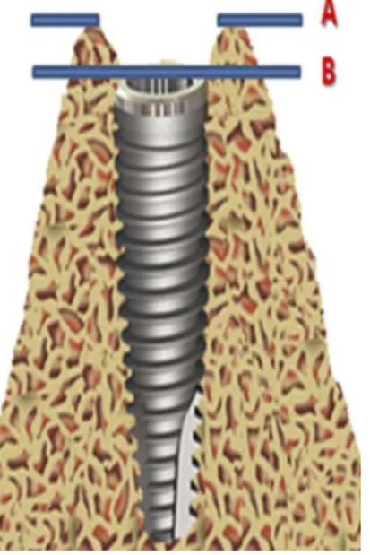 Figure 1. External Hexagon implant placed at the bone ridge level. 