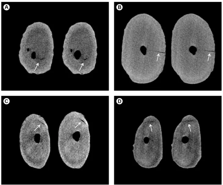 Figure 1. Representative micro-CT cross-sectional images obtained from 4 mandibular incisors, before and after root canal preparation with: (A)  WaveOne Gold when instrumentation was terminated at apical foramen (AF); (B) WaveOne Gold when instrumentation 