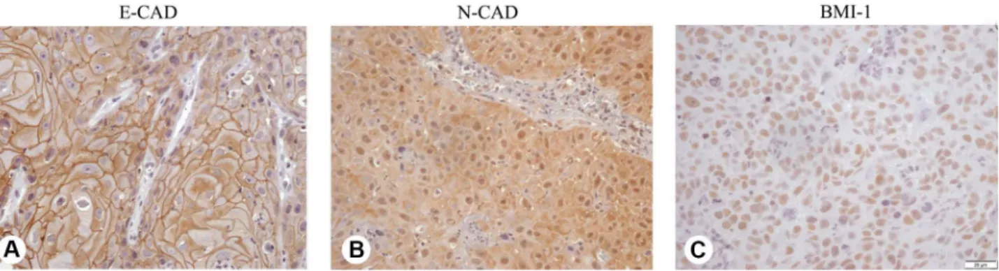 Figure 2. Immunomarkers scoring according to the histopathological  grading of the tumors