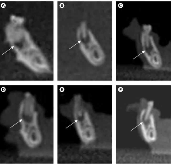 Figure 1. Coronal 0.2-mm-thick reconstructions by cone-beam computed tomography. White arrows indicate periapical lesion in G1 (A), G2 (B),  G4 (C), G5 (D), G6 (E) and G8 (F).