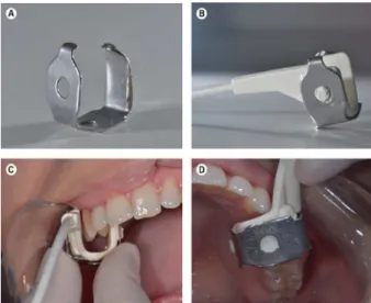Figure 1. A-D: Stainless steel probe prepared to adapt the pulse  oximeter to maxillary premolars.