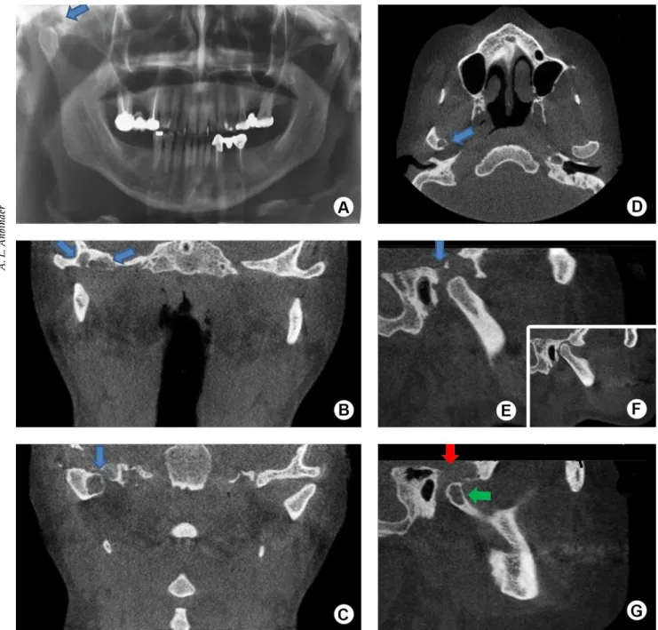 Figure 1. Imaging aspects of the lesion. A. Panoramic radiograph showing a lesion in right glenoid fossa and articular tubercle (arrow)