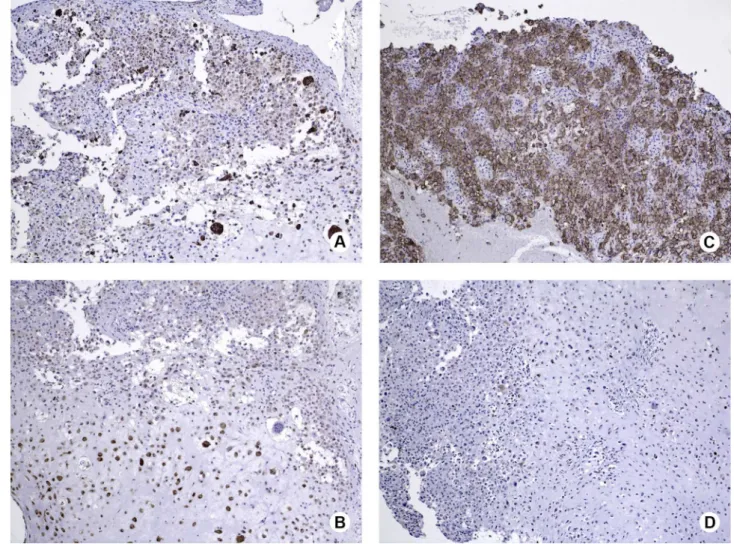 Figure 3. Immunohistochemical features of the lesion. A. Giant cells and mononuclear cells (especially histiocyte-like) showed positive  immunoreactivity for CD68
