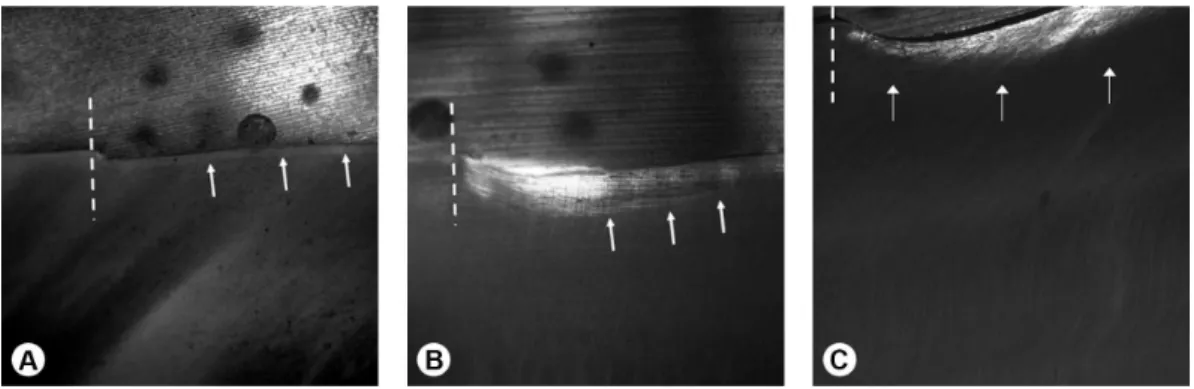 Table 3. Mean values and standard deviations (±) of erosion lesion depth  (µm) in enamel according to surface treatment and evaluation period