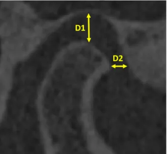 Figure 1. A: CT scan image of section; B: Numerical model and  division of the articular disc into three parts: posterior, intermediate  and anterior zones.