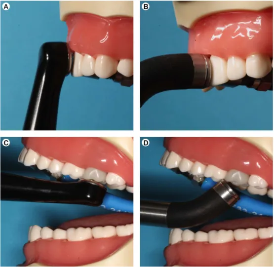 Figure 4. LCUs positioned at anterior sensor showing the ideal position of the tip parallel to the surface of the restoration, A: Valo Cordless and  B: Demetron 501