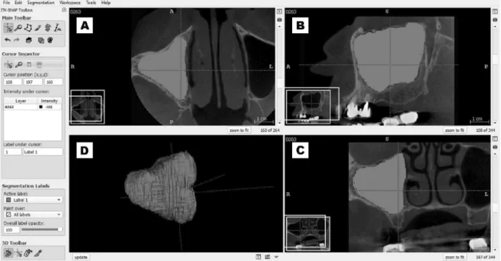 Figure 2. Representative image of segmentation of the maxillary sinus. In “A” axial view, in “B” sagittal view, in “C” coronal view, in “D” 