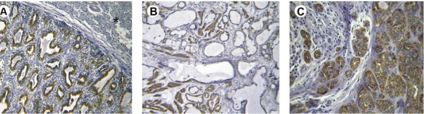 Figure 1. Immunohistochemical expression of USP44 in salivary gland tumors. Epithelial-myoepithelial carcinoma (a), mucoepidermoid carcinoma  (b) and polymorphous low-grade adenocarcinoma (c) exhibiting protein expression in the majority of neoplastic cell