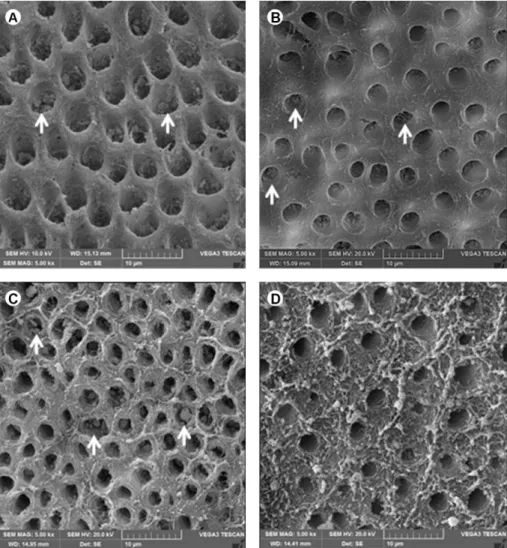 Figure 5. Dentin surface treated with Oxa-Gel. A and B: Calcium oxalate crystals within the dentinal tubules (arrow) after application