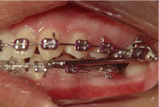 Figure 1. MPA-IV used to produce the mandibular advancement in  a patient in permanent dentition.