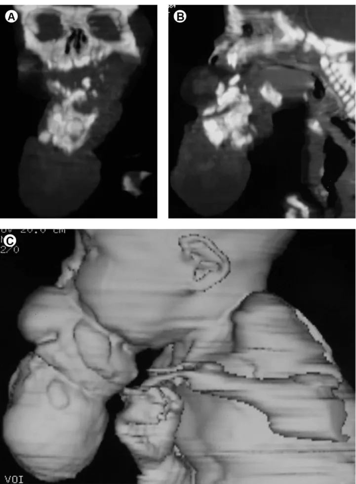 Figure 1. Pre-operative computed tomographic image of the epignathus teratoma. A: CT in coronal plane, showing multiple hyperdense images  (with density similar to the mineralized tissue) located in the anterior-lower face