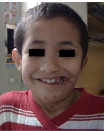 Figure 4. Clinical aspect of the child after 7 years of follow-up in  excellent general condition, with minimal facial deformity.