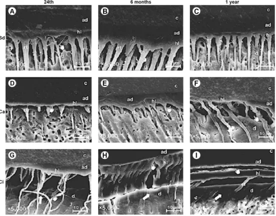 Figure 2. A: (Sd 24 h) Conventional hybrid layer (hl) conformation, presenting a continuous and homogenous bonding interface; lateral extensions  of micro tags branching off at angles from the main resin tags (rt) are visible (pointer); B: (Sd 6 months) ta