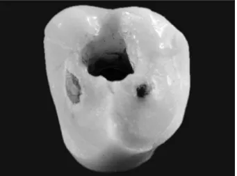 Figure 4. Fracture pattern involving the occlusal and surrounding  surfaces of the crown.