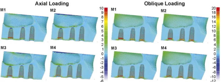 Figure 3. Maximum principal stress maps of distribution on cortical and trabecular bone tissue