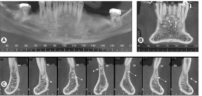 Figure 1. Periapical COD. CBCT images (A, panoramic; B, coronal; and c, cross-sectional reconstructions) showing well-defined, hyperdense lesions,  surrounded by hypodense rim, located in the periapex of the mandibular anterior teeth (arrows) and leading t
