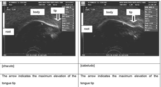 Figure 4.  Frame  obtained in the maximum elevation of the tongue tip in the  /r/ and in the /l/ in the word, in one of the five subjects