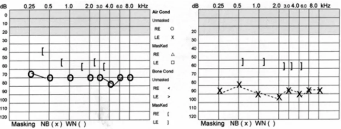 Figure 1. Tone audiometry of the right and left ears, respectively