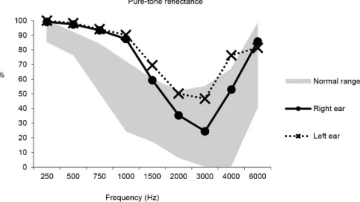 Figure 3. Reflectance results with pure-tone stimulus in both ears