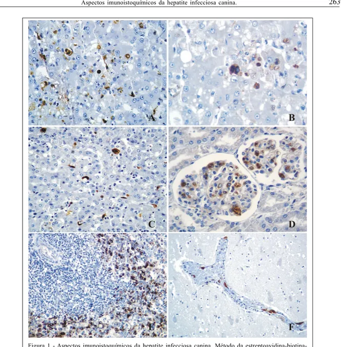 Figura 1 - Aspectos imunoistoquímicos da hepatite infecciosa canina. Método da estreptoavidina-biotina- estreptoavidina-biotina-peroxidase (contra-coloração com Hematoxilina de Harris)