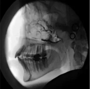 Figure 4. Videofluoroscopy lateral view showing velopharyngeal closure  during speech