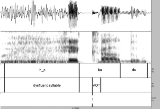 Table 3 also shows a comparison of speech environments  for PWS. For these speakers, VOT is usually longer in  post--dysfluent speech, while occlusion time and total duration are  longer in fluent speech