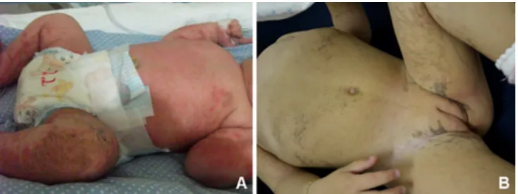 Figure 1. Dermatological findings among patients of the Incontinentia Pigmenti sample