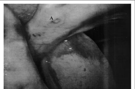 Figura 2 - Implante de costela (A) envolto por pulmão (B) após substituição de costela conservada em açúcar