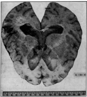 Fig. 1 — Corte transversal do cérebro mostrando a  dilataçâo dos ventrículos laterais e foramens de Monro