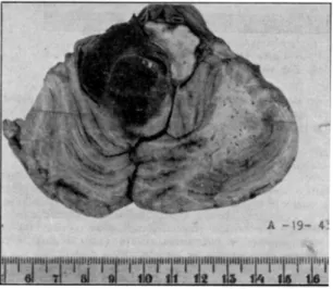 Fig. 3 — Maior detalhe (b da fig. anterior) do comprome- comprome-timento bulbar. Do hemibulbo direito só a oliva e a pirâmide 