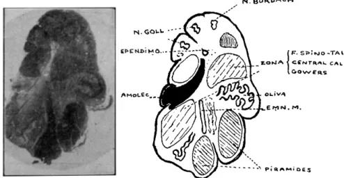 Fig. 4 — Nivel dos núcleos de Goll e Burdach  ( W e i g e r t ) . Relativa deformação  do bulbo com achatamento lateral