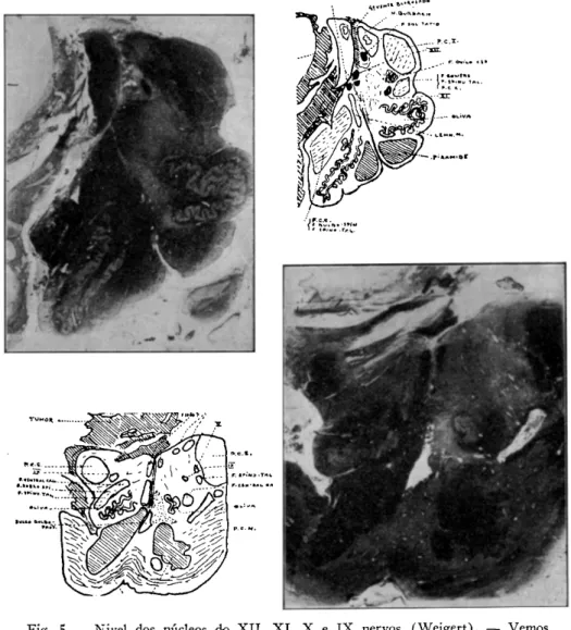 Fig. 6 — Nivel da zona de passagem bulboprotuberancial  ( W e i g e r t ) . — O tumor  se apresenta multiforme