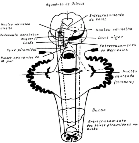 FIG. 3 — (De um esquema de Bing, modificado). Lesão à direita, interessando as  fibras do III par diretamente e o pedúnculo cerebelar esquerdo, após o  entrecruza-mento de Wernekink: ipsilateralidade cerebêlo-piramidal, pois ambas as vias se  entrecruzarão