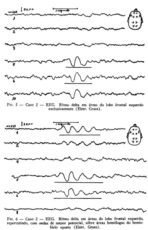 FIG. 6 — Caso 2 —  E E G .  R i t m o delta em áreas do lobo frontal esquerdo,  repercutindo, com ondas de menor potencial, sobre áreas homólogas do 