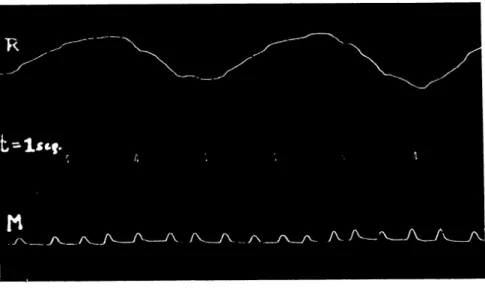FIG. 2 — Registro gráfico da respiração  ( R ) e das mioclonias  ( M )  para mostrar as caraterísticas dos movimentos mioclônicos