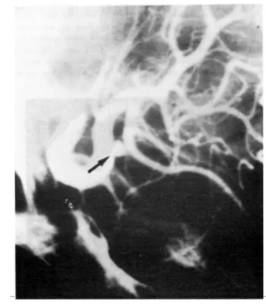 Fig. 2 — Case JRM. Angio- Angio-graphic study of the  right internal carotid  artery showing the  aneurysm in the dorsal  wall of this artery,  be-tween the ophthalmic  and the posterior  com-municating arteries  (ar-row)