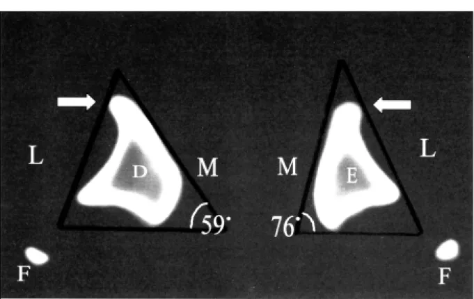 Figura 2 - Imagem tomográfica em que se verifica desvio lateral de 17 o  quando comparada à crista direita com a esquerda